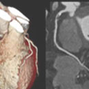 Cardiac CT